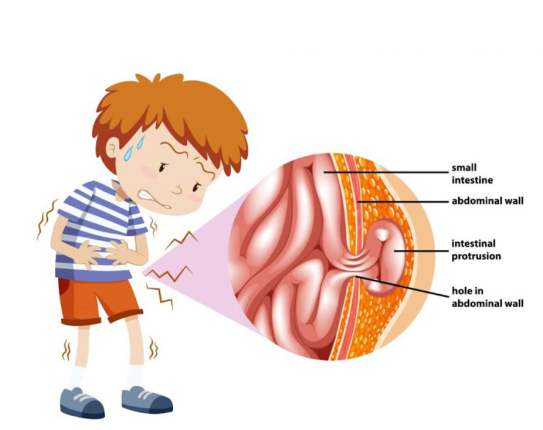 Çocuklarda Kasık Fıtığı | Inguinal Hernia | Çocuk hastalıklar | Dr Remzi Erdem | Üroloji doktoru