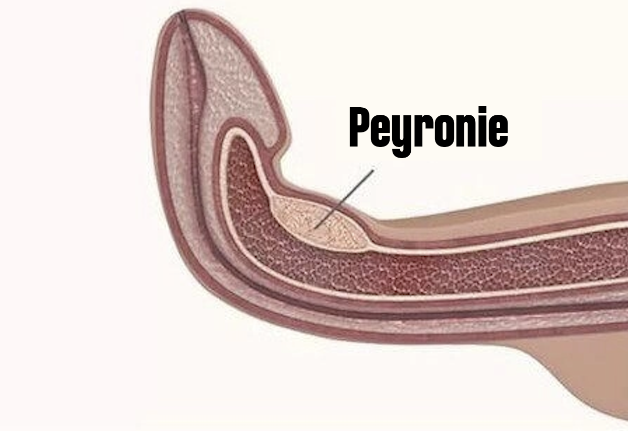 Penis Eğriliği | Peyronie | Penis Büyütme | Cinsel hastalıklar | Dr Remzi Erdem | Böbrek taşı | Üroloji doktoru