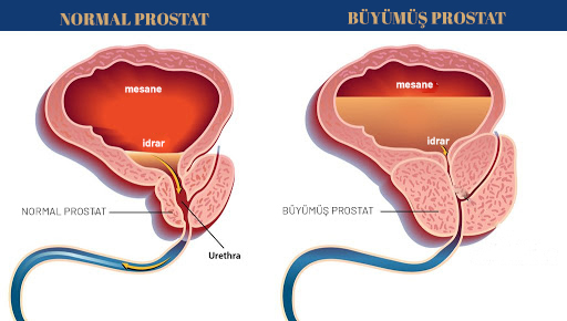 Prostat büyümesi | prostat kanseri | uzman doktor | Holep yöntemi | Dr Remzi Erdem