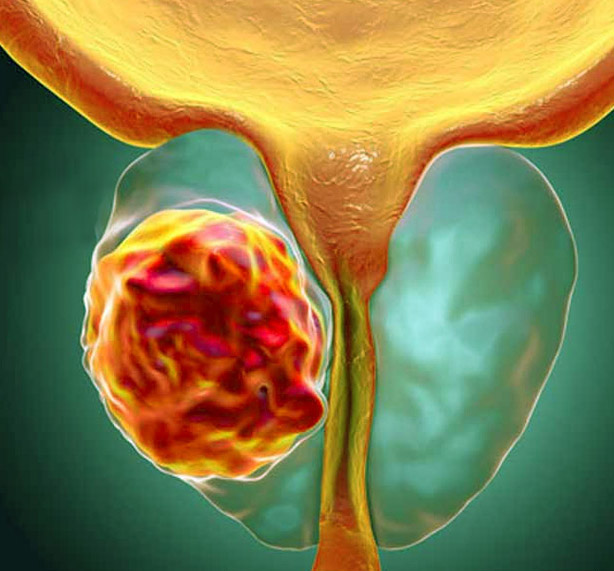 prostat Kanseri | Dr Remzi Erdem | Prostat | Üroloji doktoru
